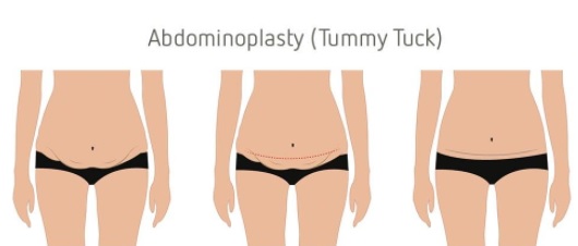 Abdominoplasty Fact Sheet