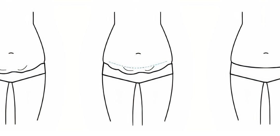 Abdominoplasty Fact Sheet