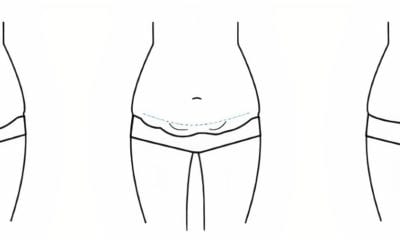 Abdominoplasty