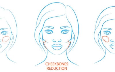 Cheekbone Reduction