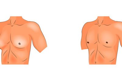 Gynecomastia