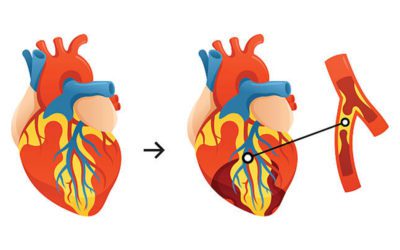 Hearth Bypass