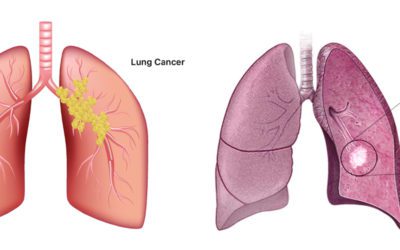 Lung Cancer