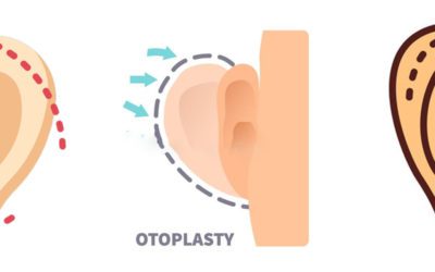 Otoplasty