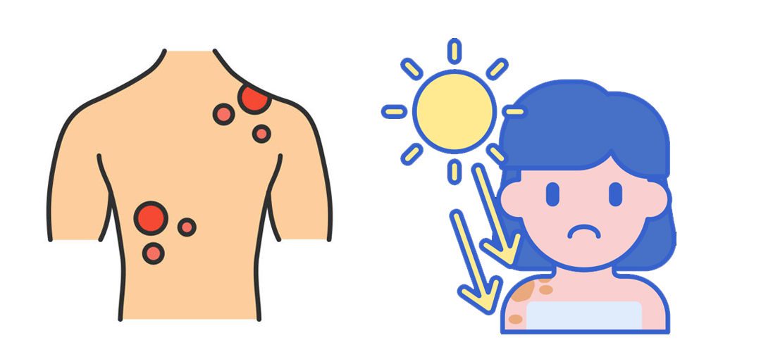 Skin Cancer Cartoon